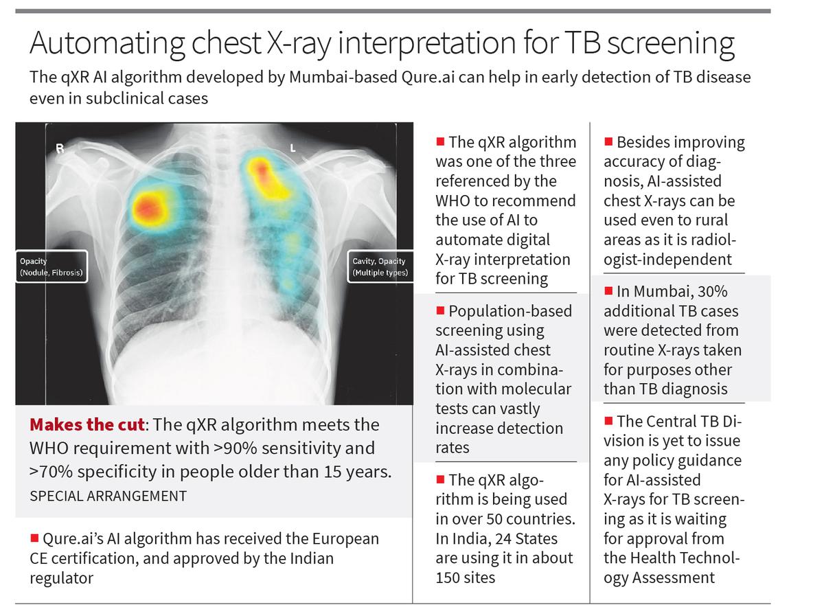 Chest Xray interpretation using AI can detect more TB cases The Hindu